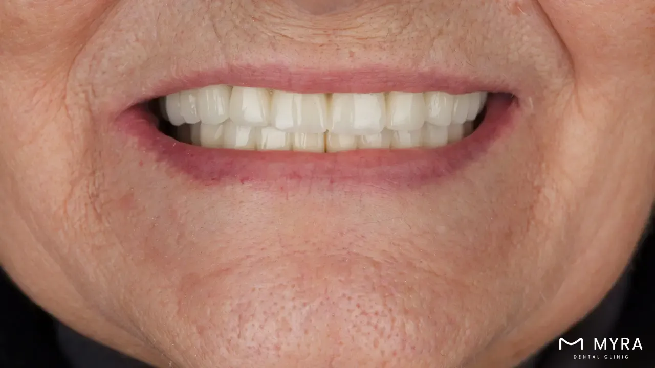 Nasolabial folds or smile line