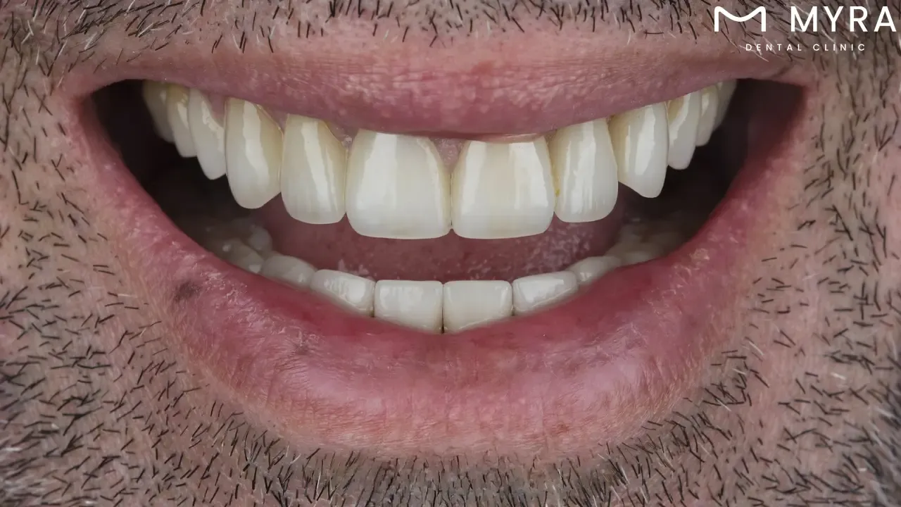 Natural wear and tear makes veneers more porous and stainable