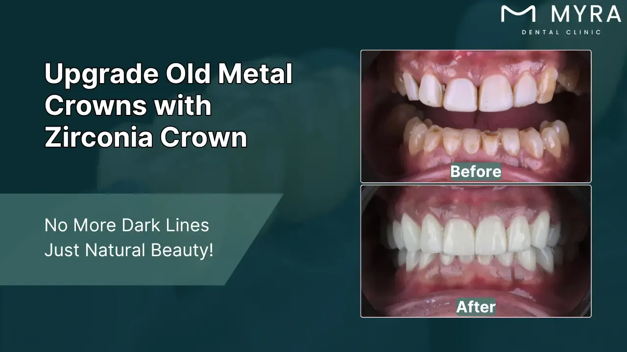 old metal crowns or fillings