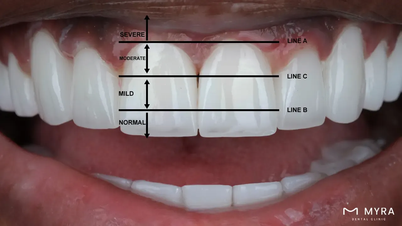 Open gingival embrasures