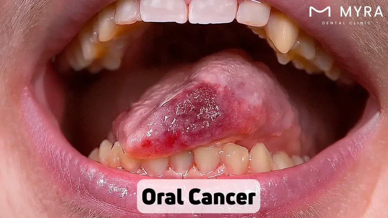 Oral cancer: Symptoms, treatment, and causes