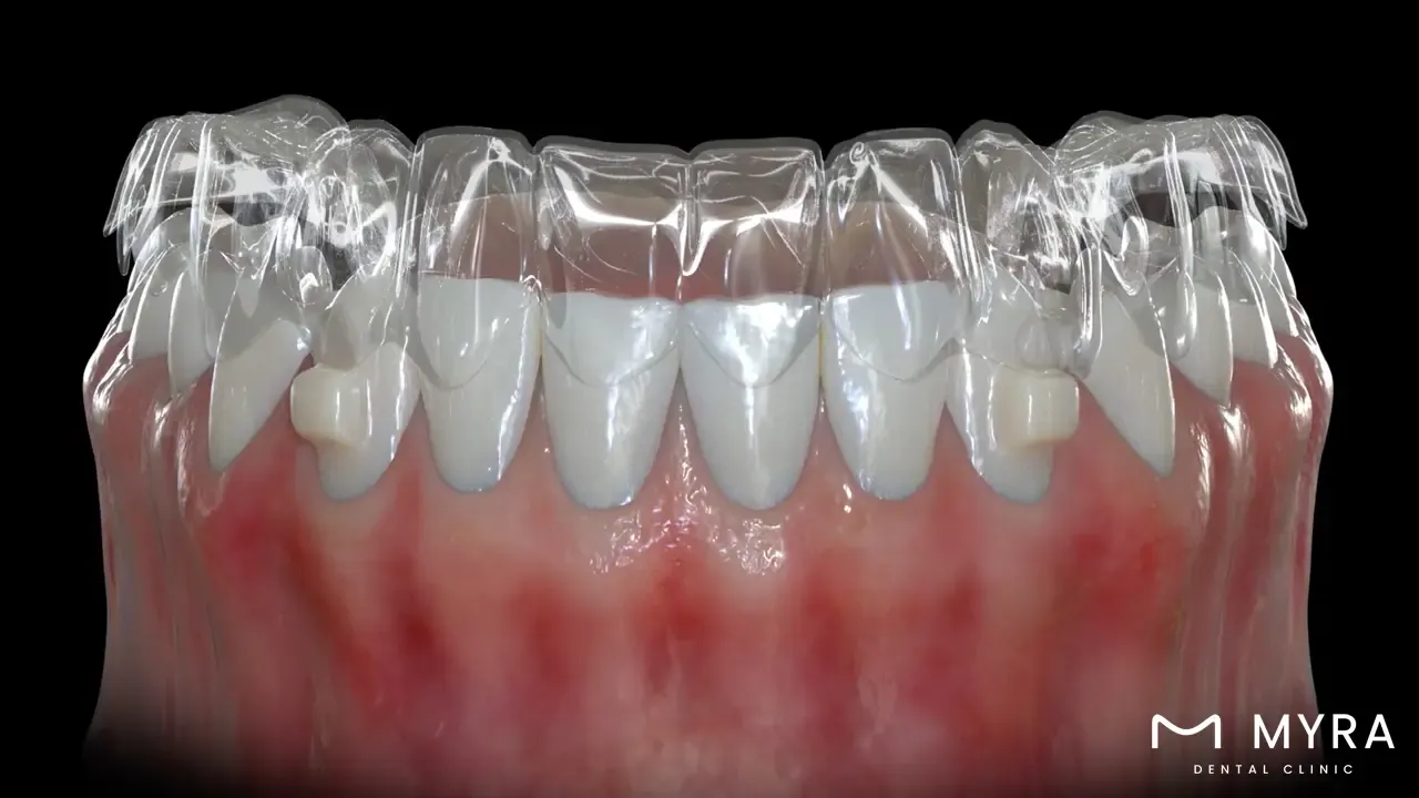 Orthodontic treatment for facial aesthetics