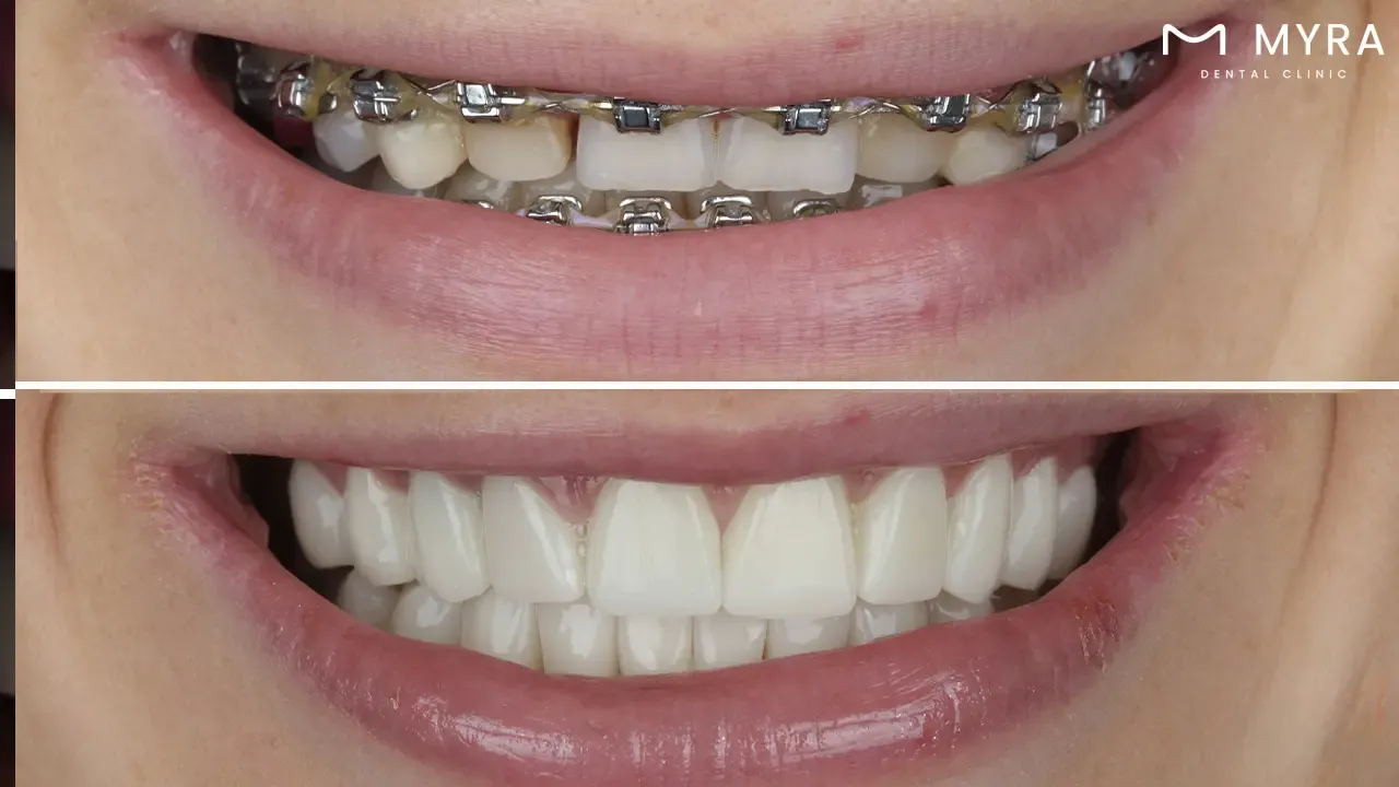 Orthodontics in smile design