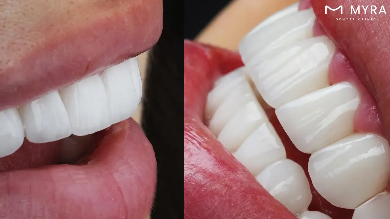 Palatal veneers