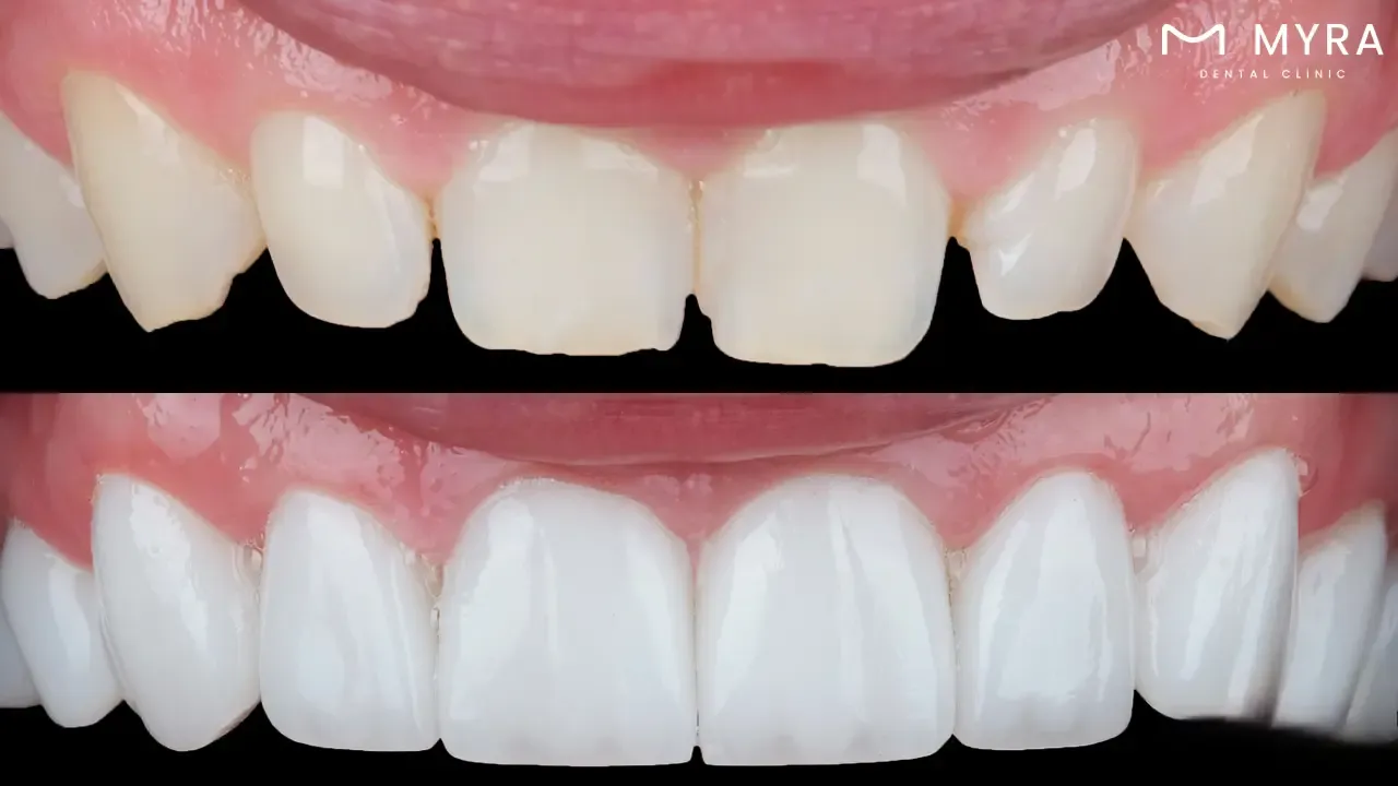 Porcelain veneering in smile design