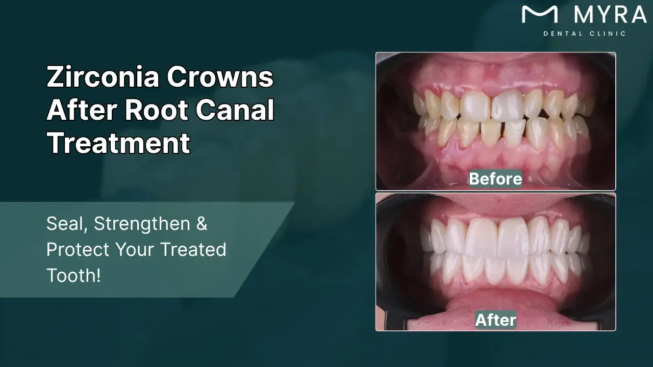post-root canal protection