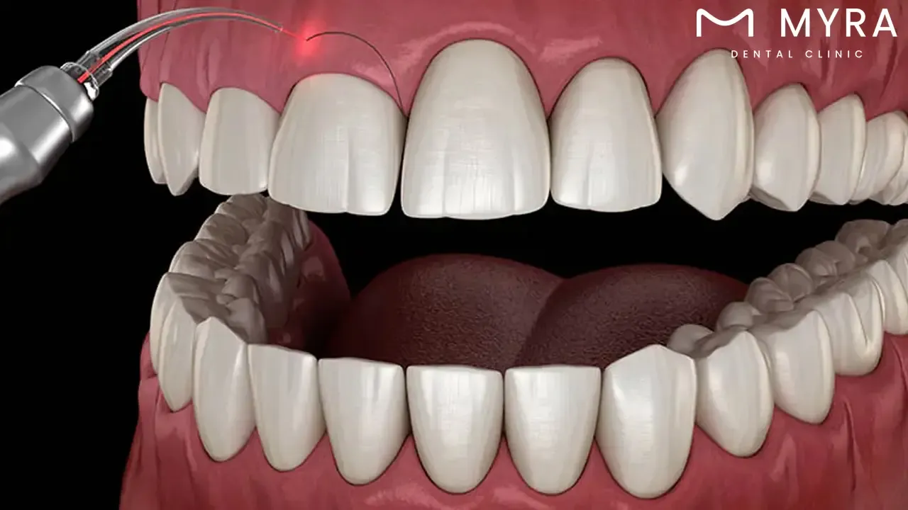 The process of laser gum contouring