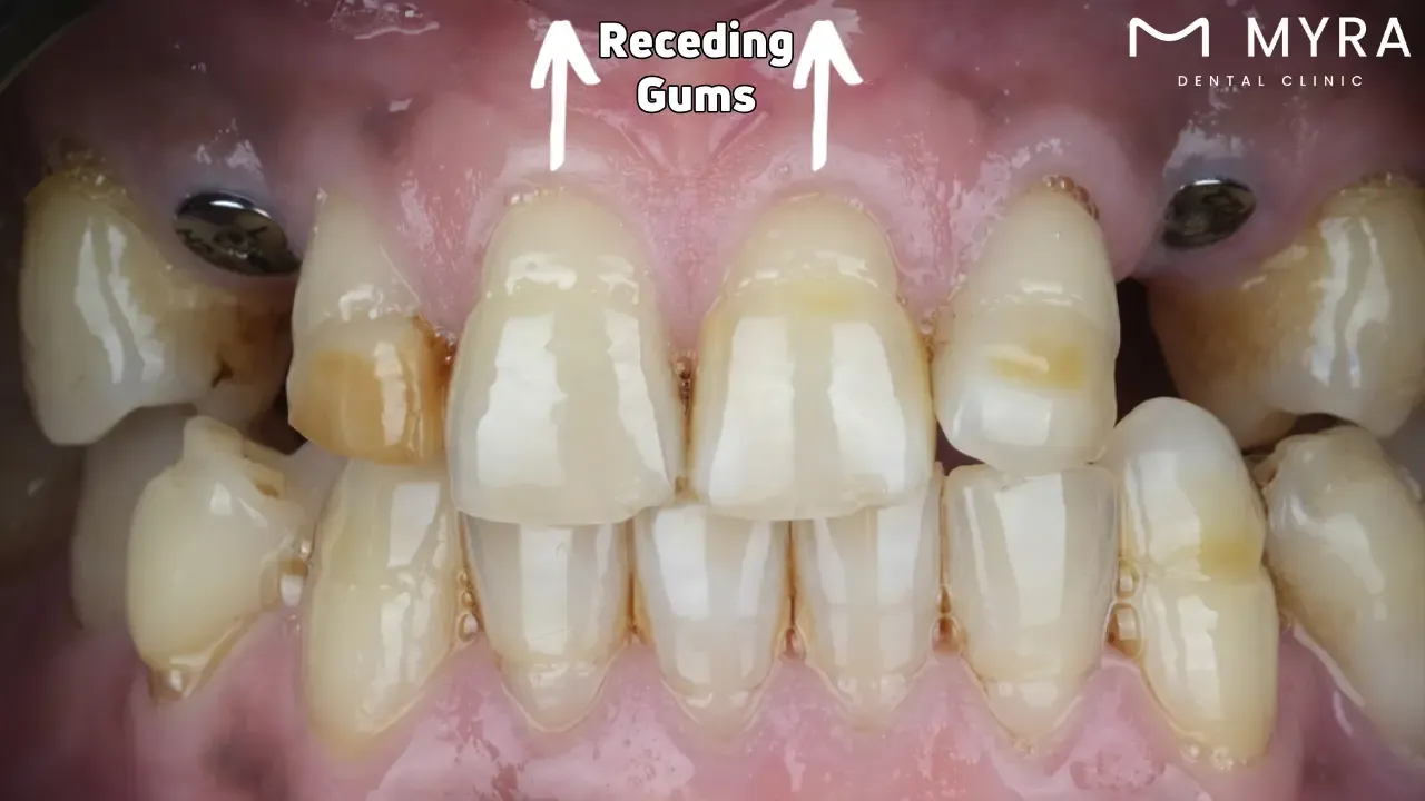 Receding gums