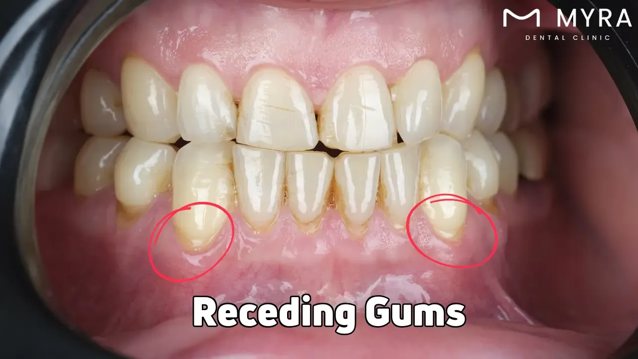 Receding gums: Symptoms, treatment, and causes