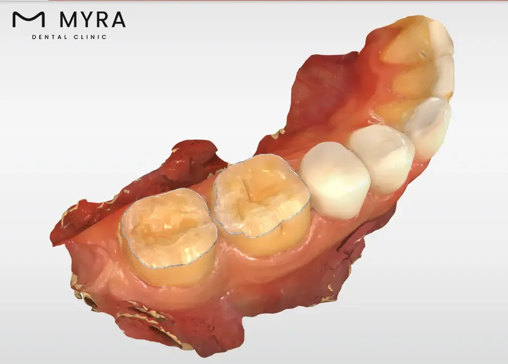 resin-modified-glass-ionomer-fillings.webp