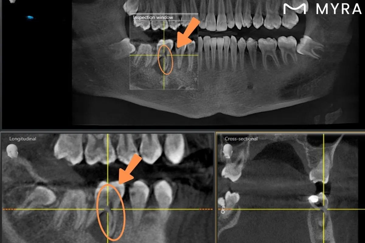 root canal infection 3d rontgen