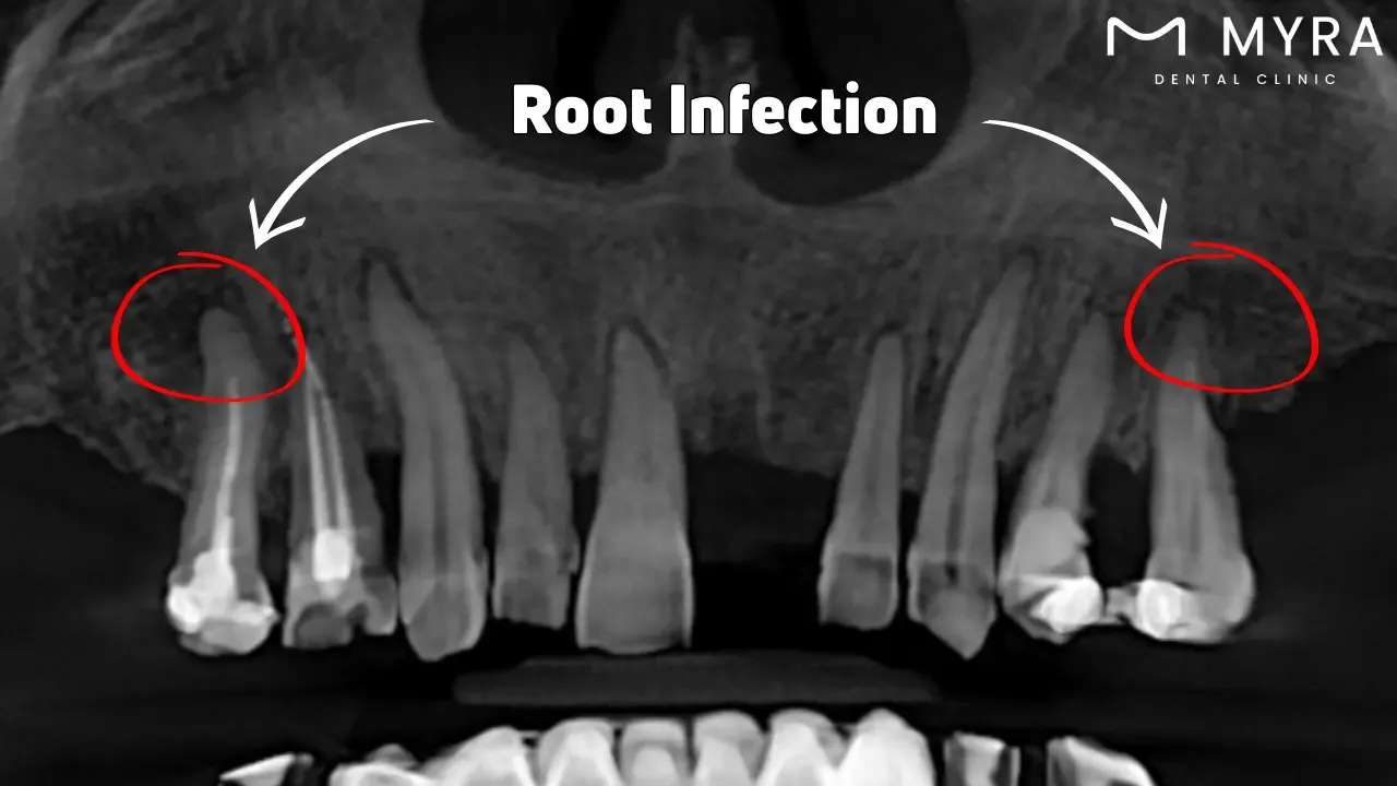 Root infection
