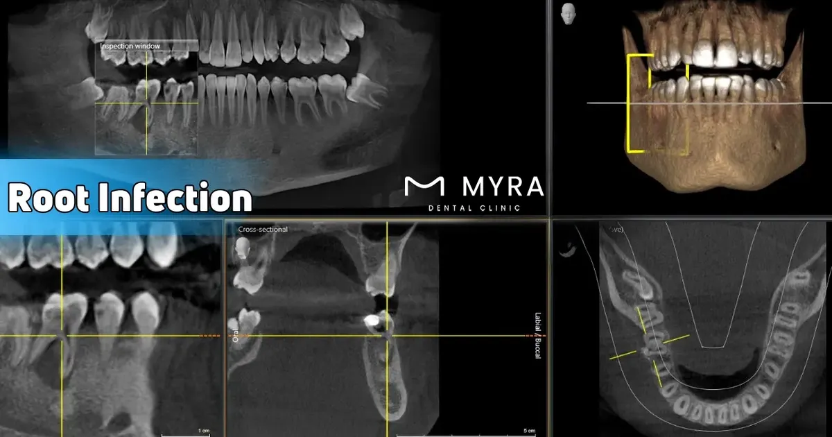 root-infection-symptoms-treatment-causes
