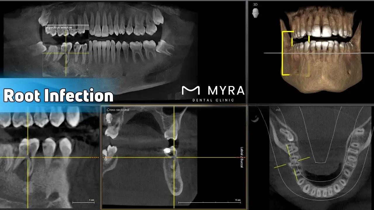 Root infection: Symptoms, treatment, and causes