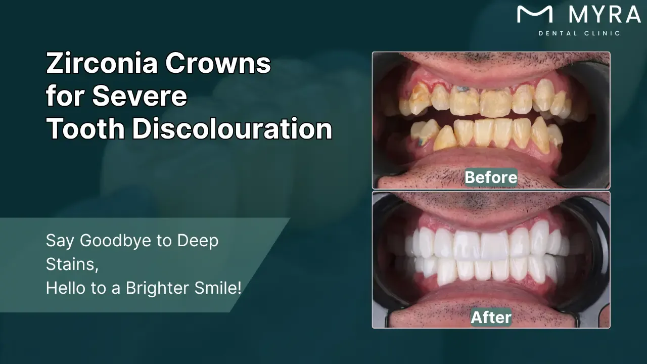 severe discolouration
