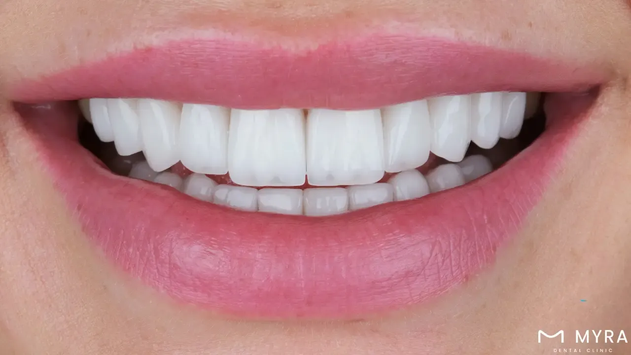 Side effects of dental veneer