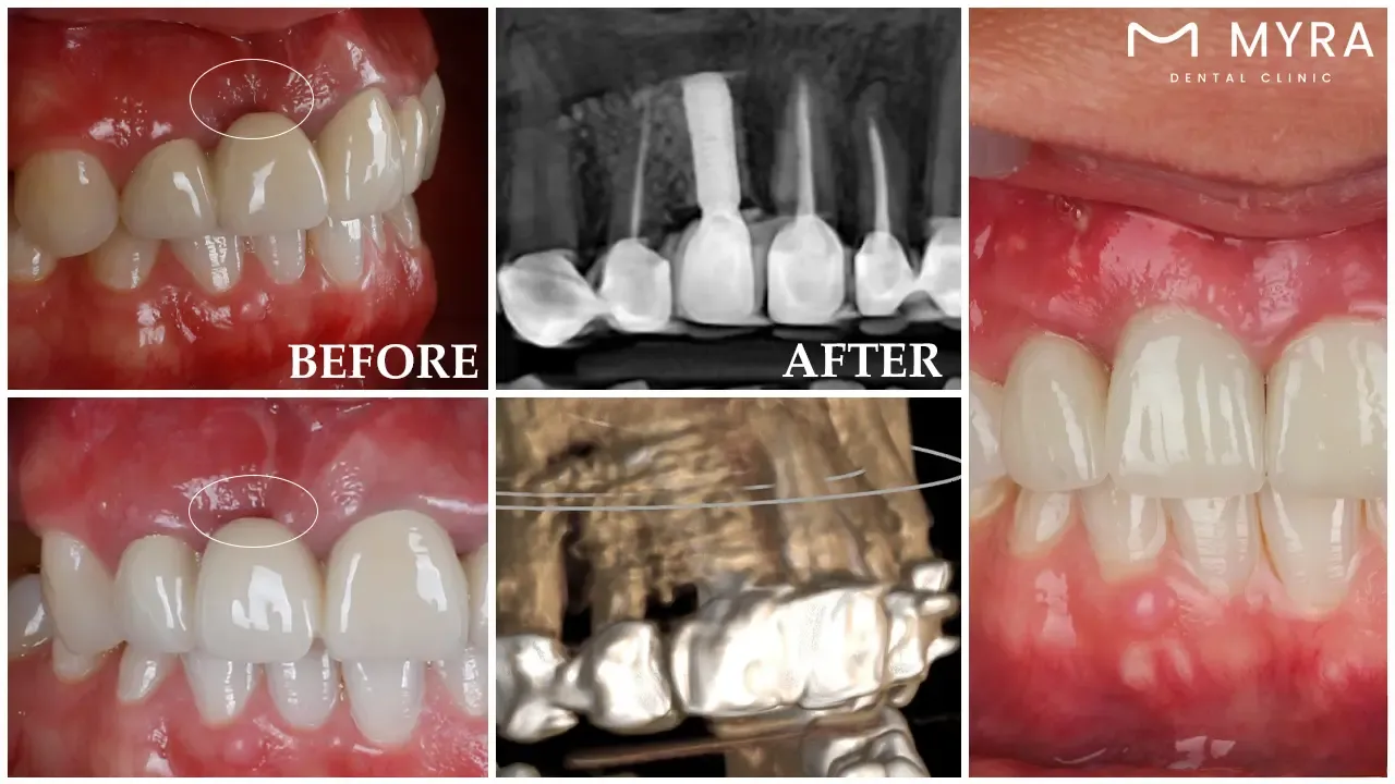 single tooth dental implant: definition, benefits, procedure, and average cost