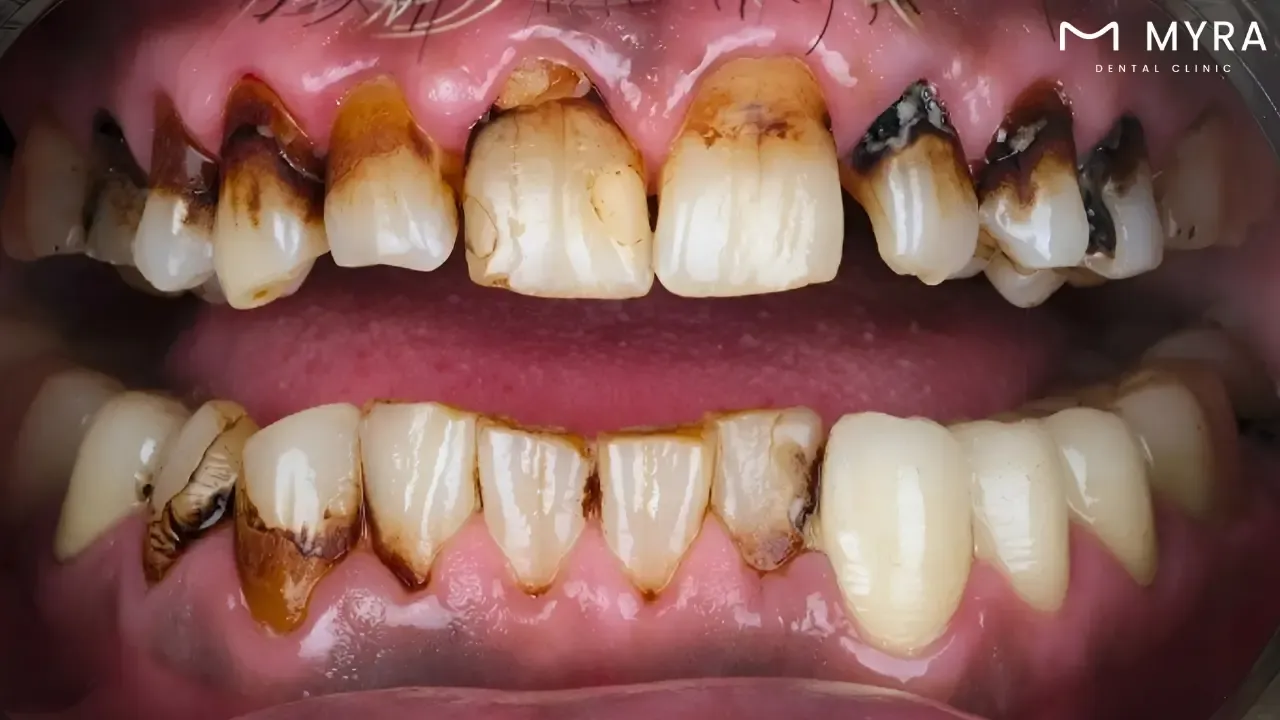 Stained teeth: Symptoms, treatment, and causes