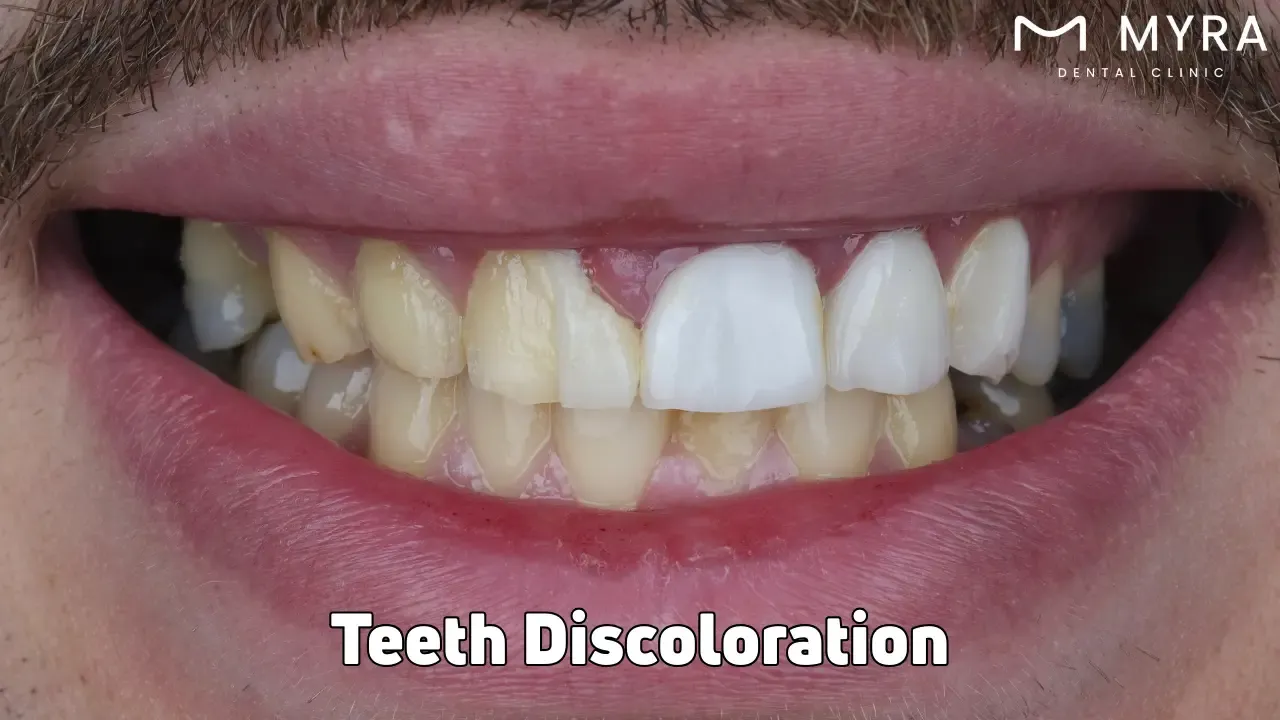 Teeth discoloration