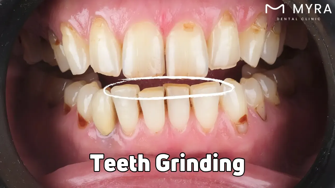 Teeth grinding
