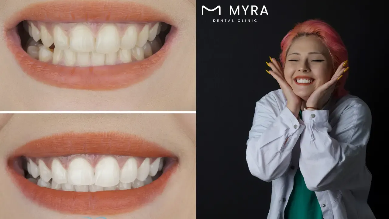 Teeth whitening in turkey
