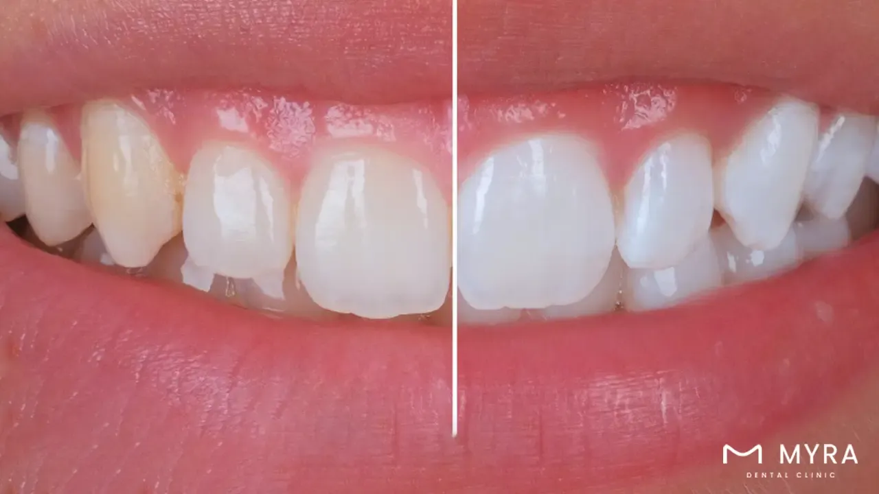 Teeth whitening in turkey