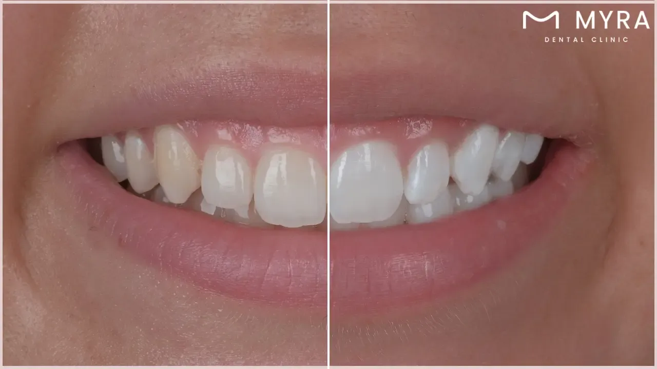 Teeth whitening vs. dental laminates: What are the differences?