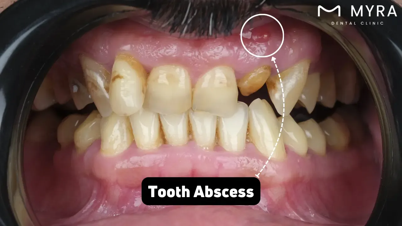 Tooth abscess: Symptoms, treatment, and causes