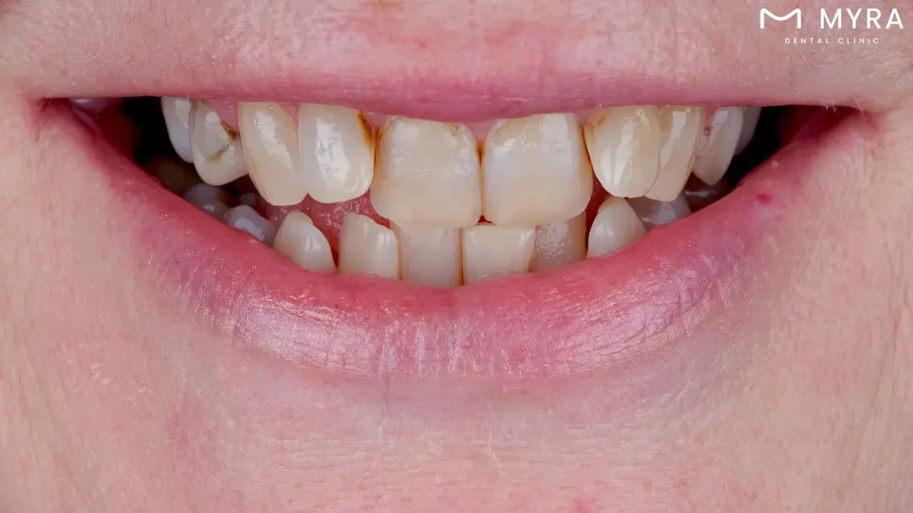 Tooth alignment