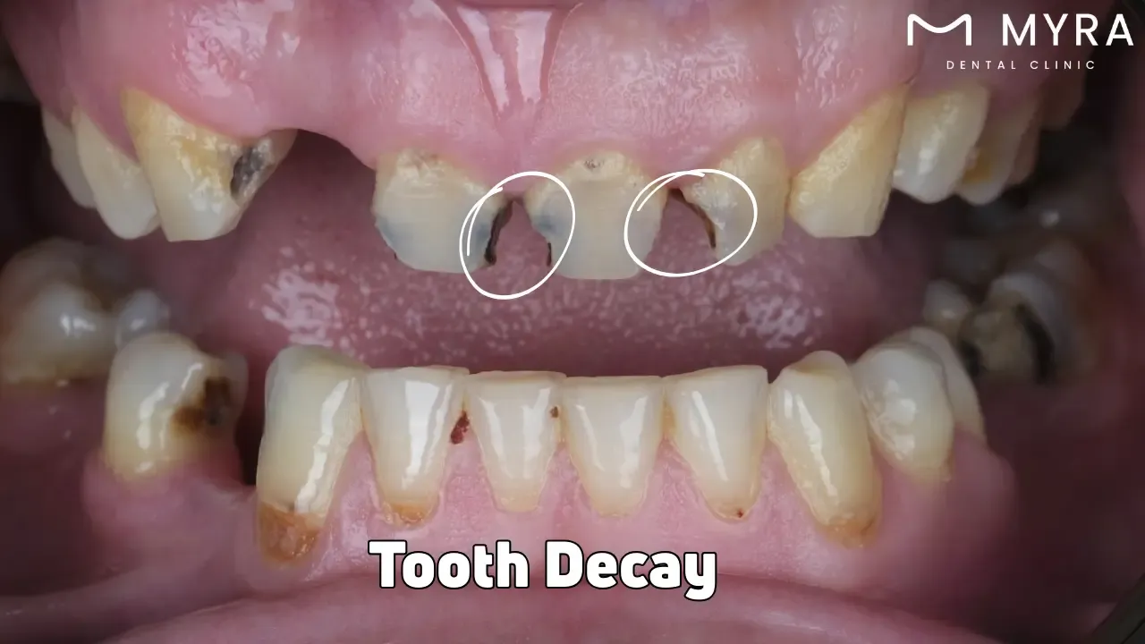 Tooth decay