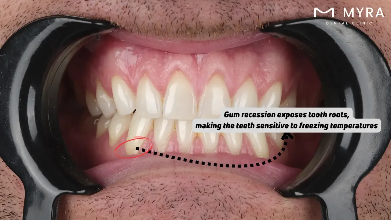 Tooth decay or gum disease