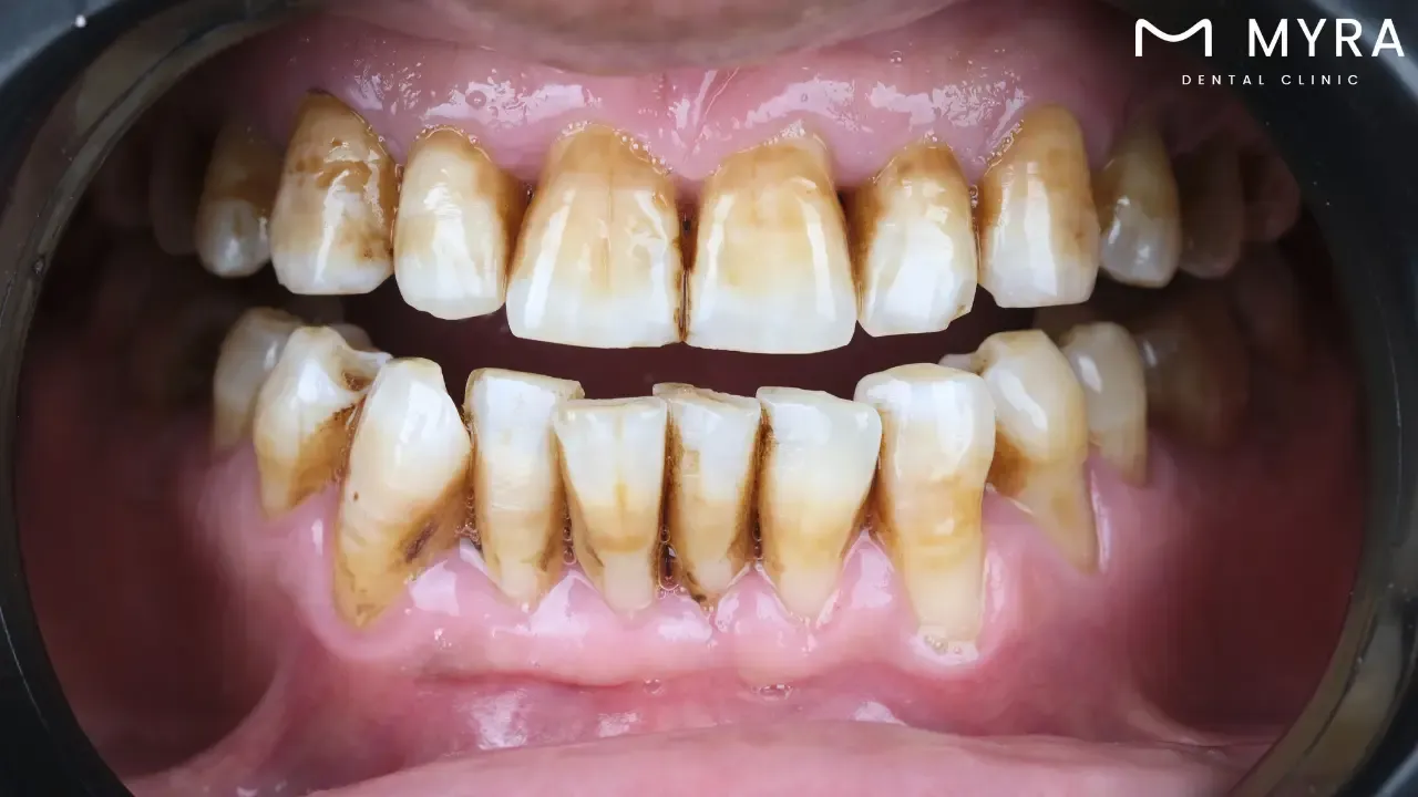 Tooth decay: Symptoms, treatment, and causes