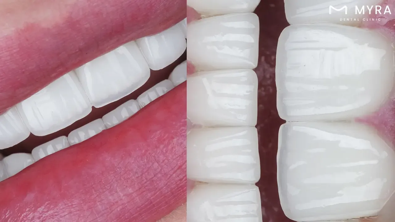 Traditional porcelain veneers