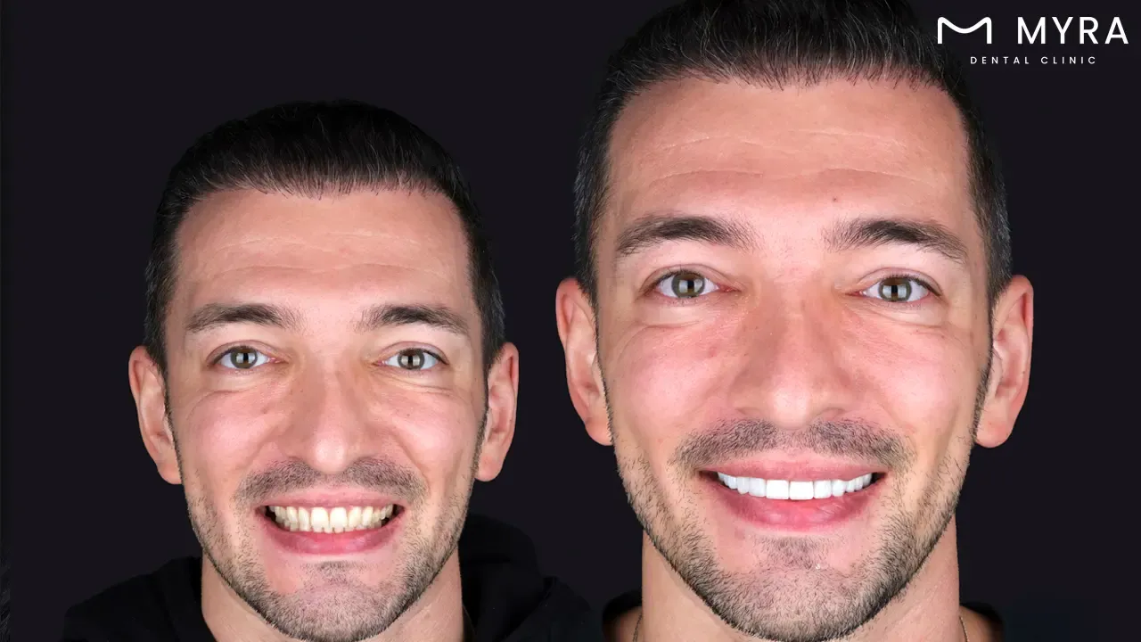 Turkey veneers cost: Price considerations and comparisons