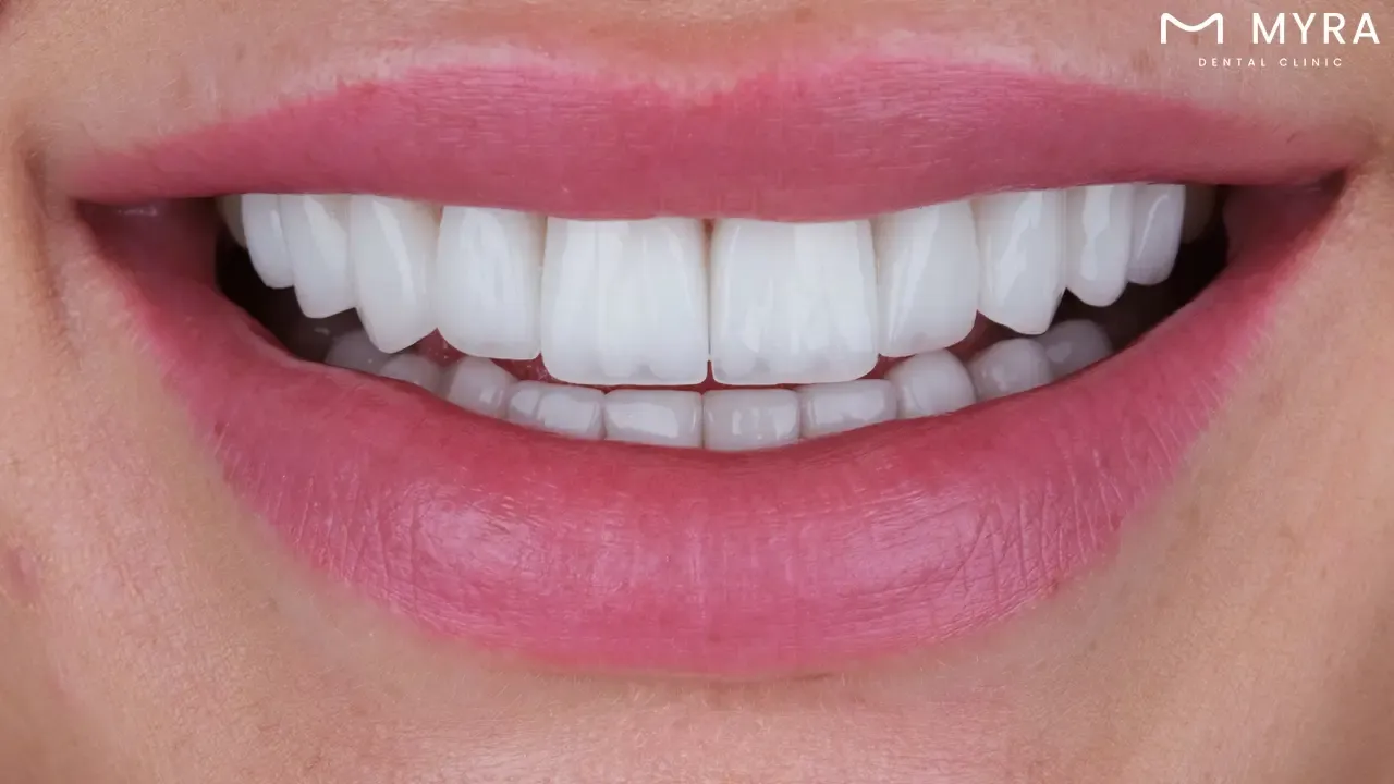 Typical veneer quantity: What number is common for dental transformation?