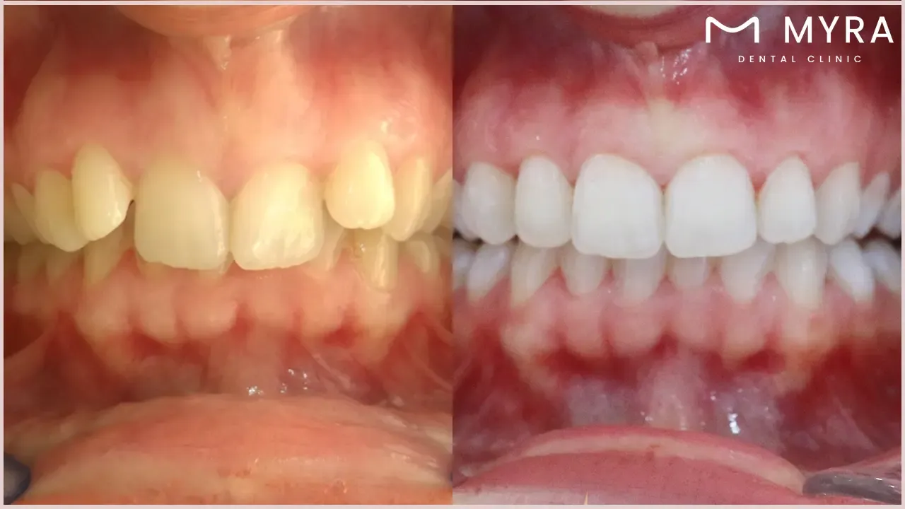 Uneven results of teeth whitening