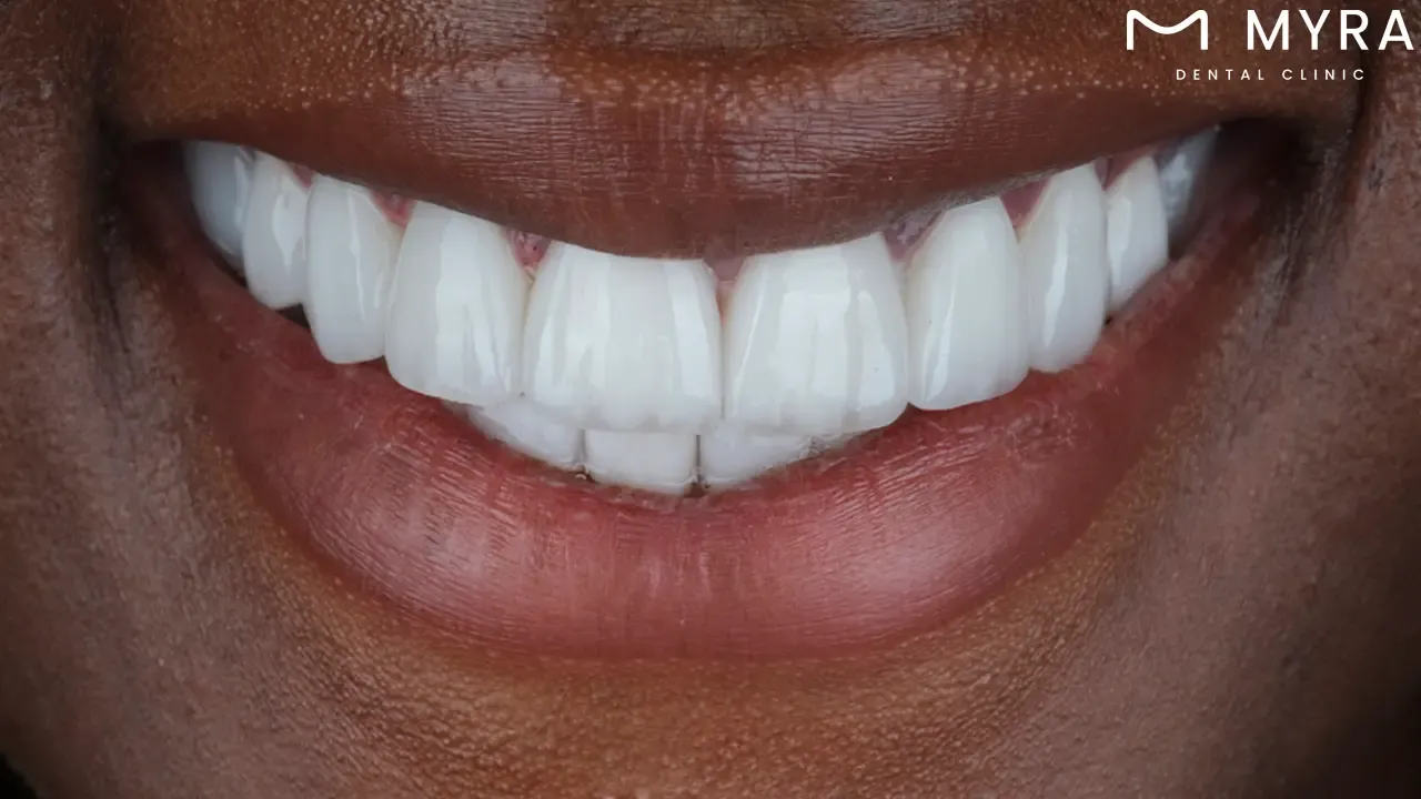 Veneer stains: Causes and prevention