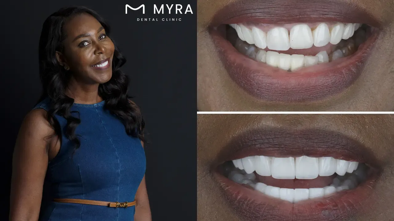 Veneers in turkey