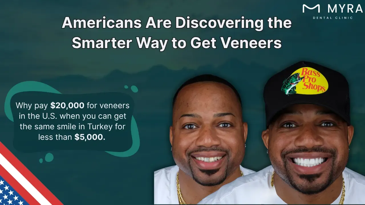 Veneers in usa vs. turkey: Prices, pros, and cons