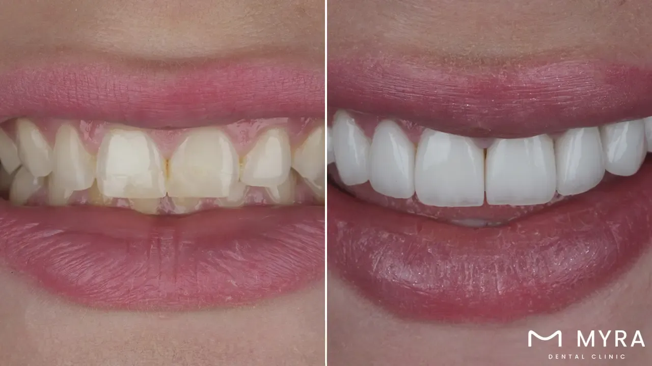 Veneers transformation before and after