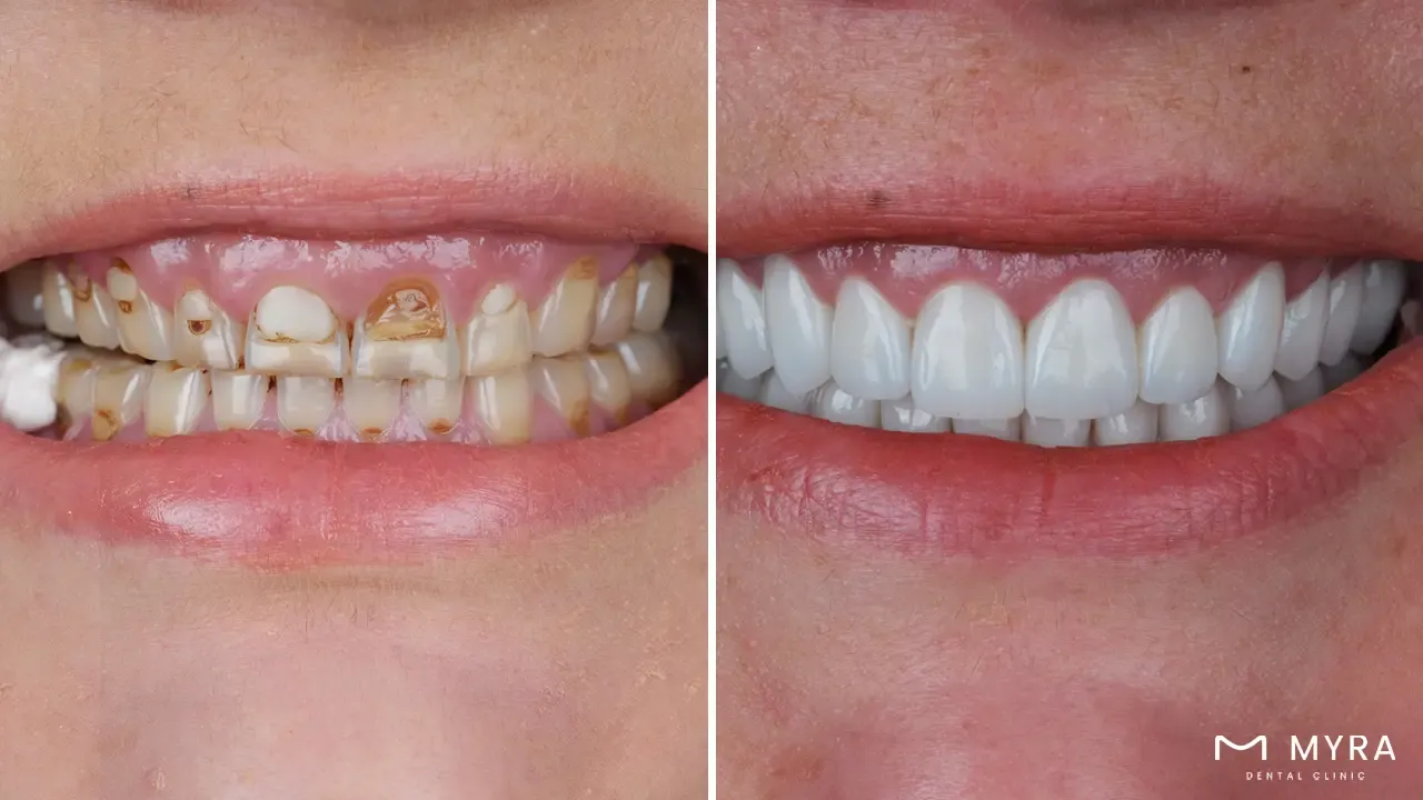 Vertical dimension of occlusion