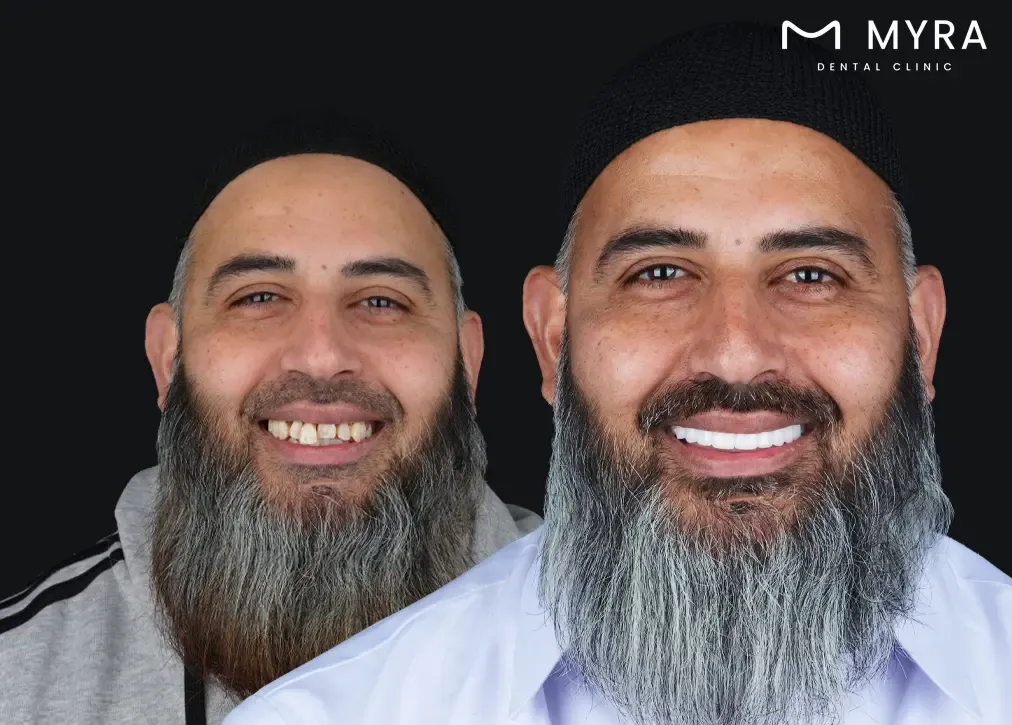 What are dental veneers