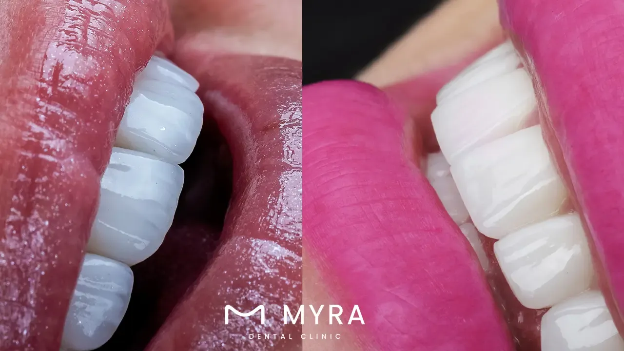 What are dental veneers