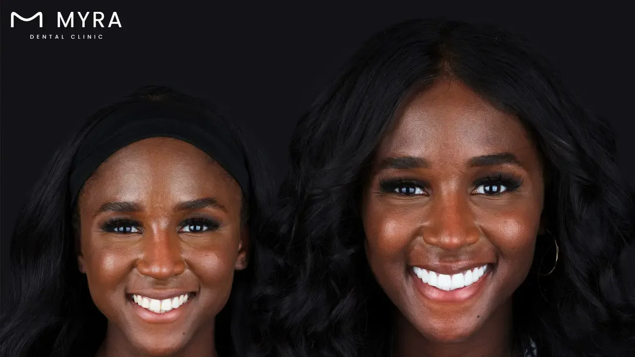 What are dental veneers?