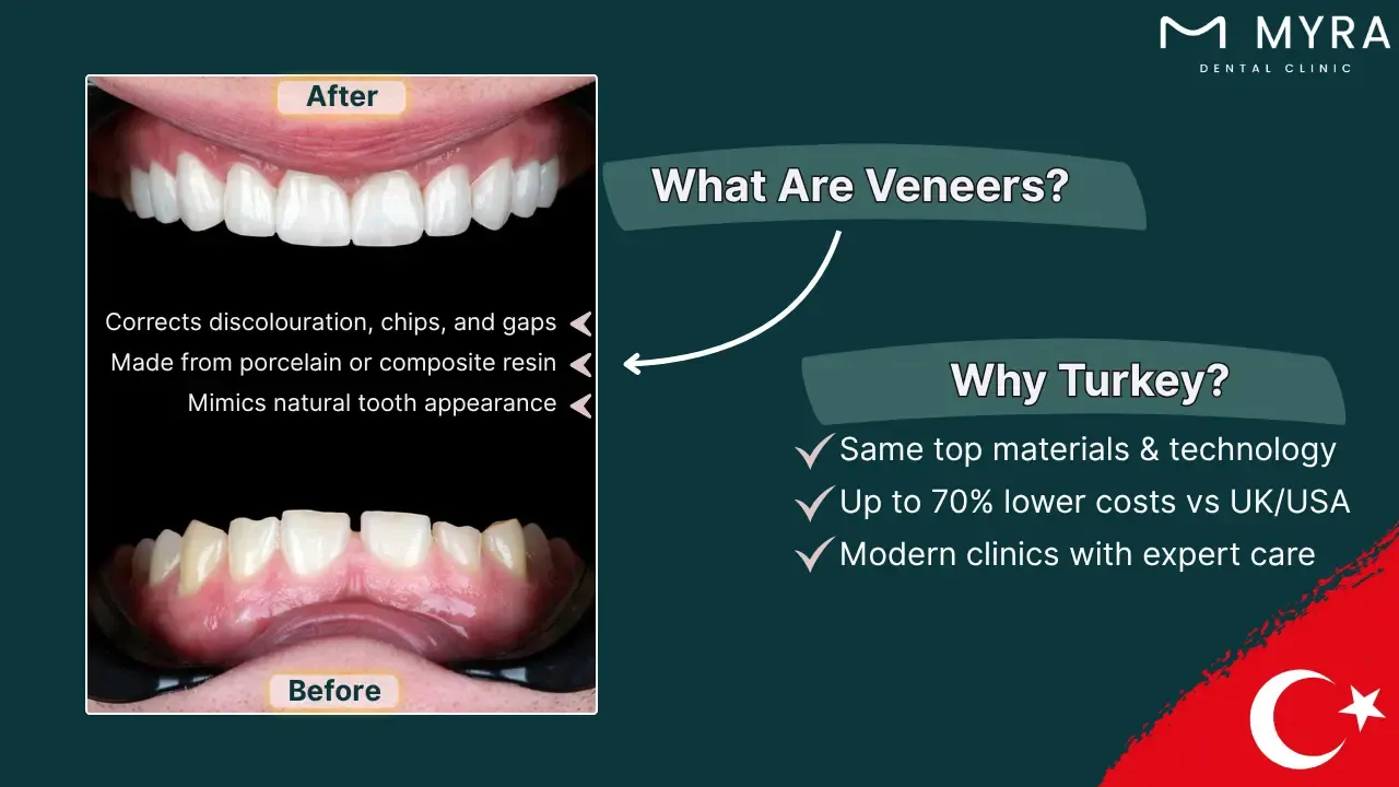 What are dental veneers in turkey