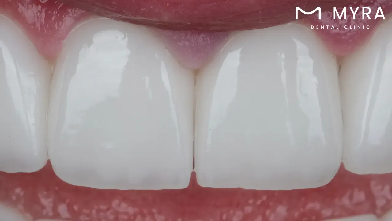 What are maxillary central incisors?