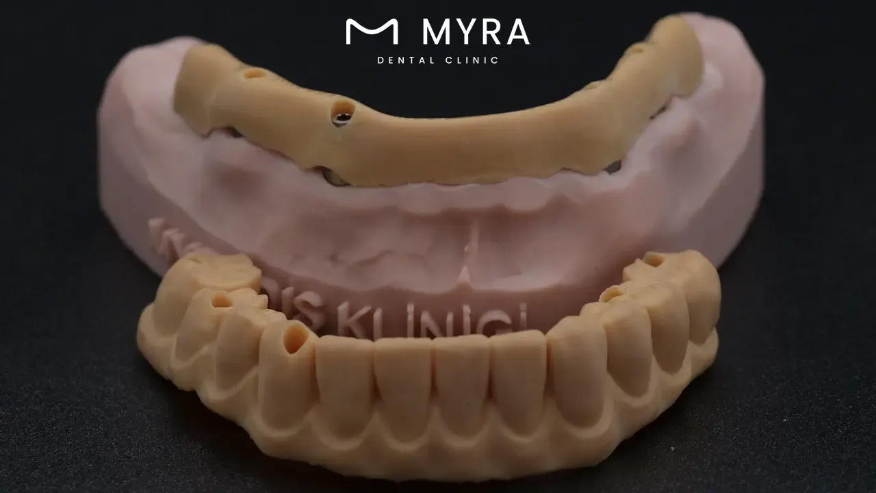 What are the advantages of dental crowns compared to dental bridges?