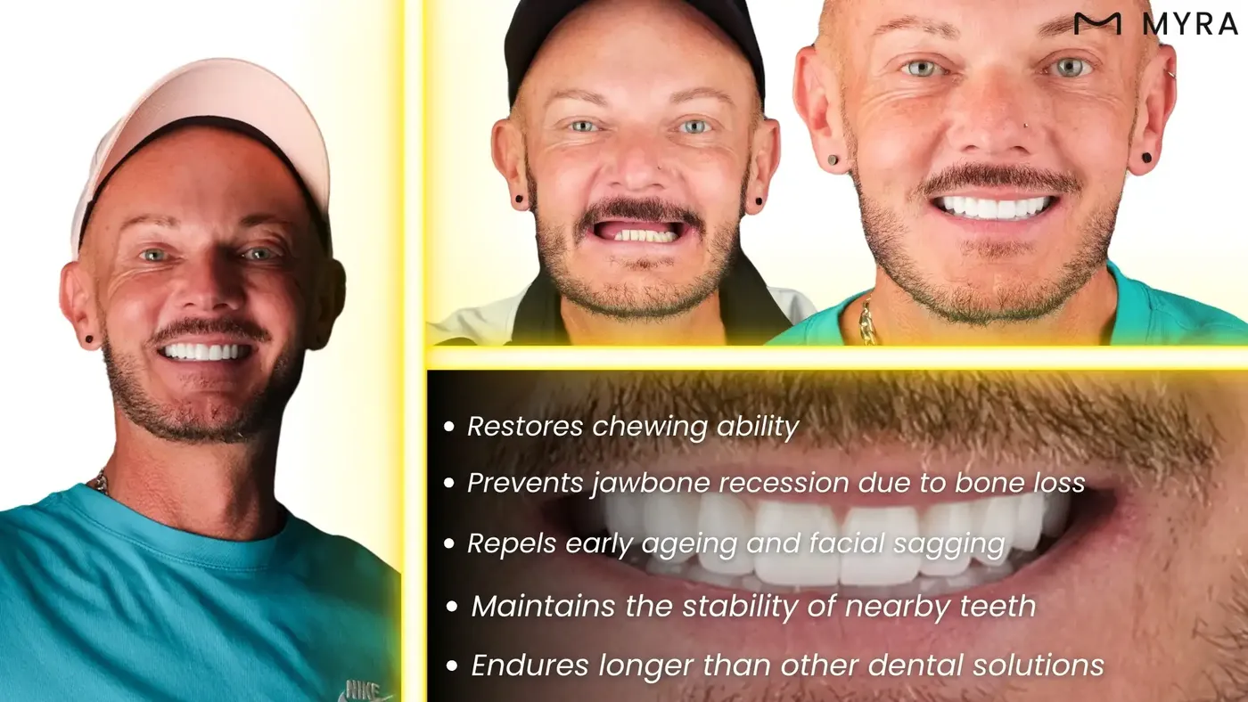 what are the advantages of a dental implant?