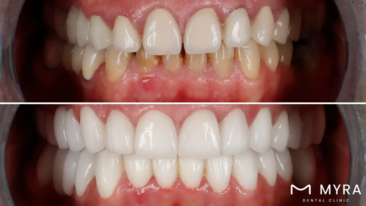 What are the advantages of gingival esthetics?