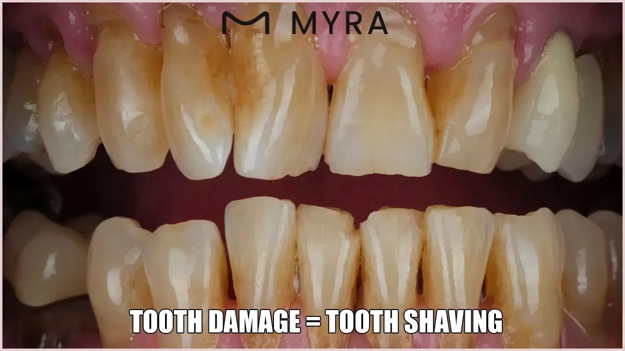 what are the advantages of having enamel shaping treatment?